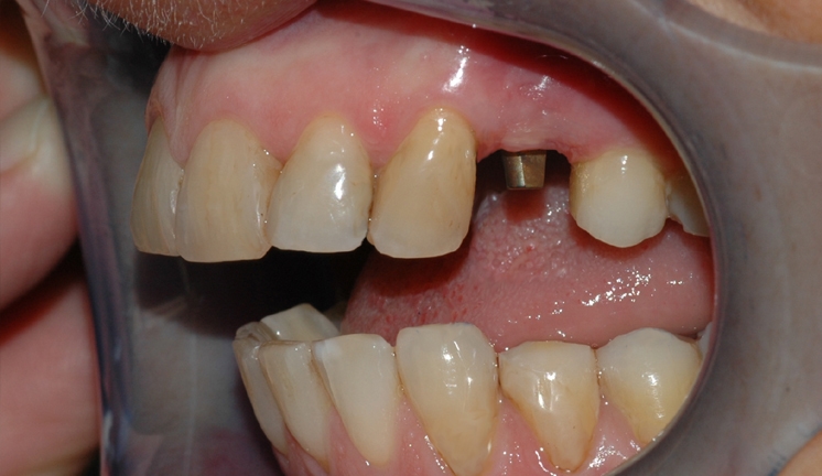 implantat klinisk 2