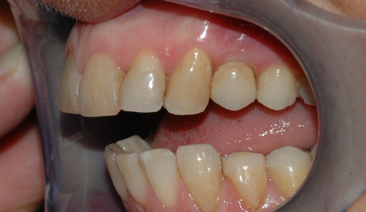 implantat klinisk 3