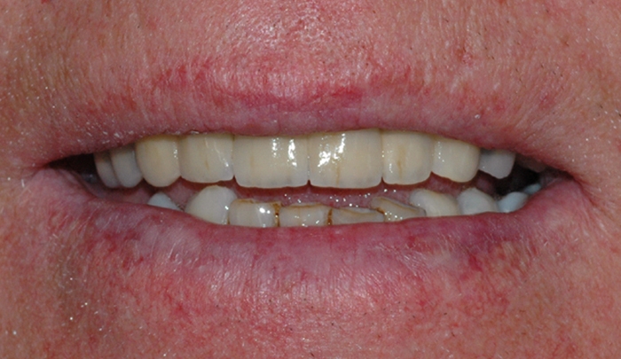 implantat klinisk 5