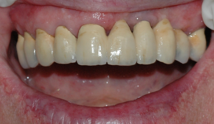 implantat klinisk 6