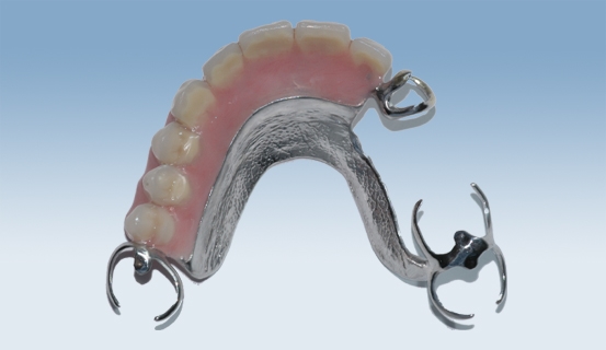 a vitallium 4